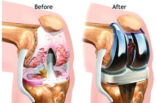 ACL Ligament doctor in delhi and near me